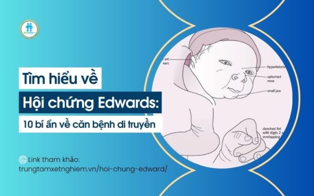 hội chứng edward