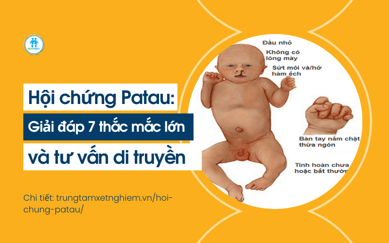 hội chứng patau