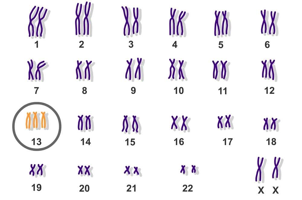 nhiễm sắc thể trisomy 13 hội chứng patau