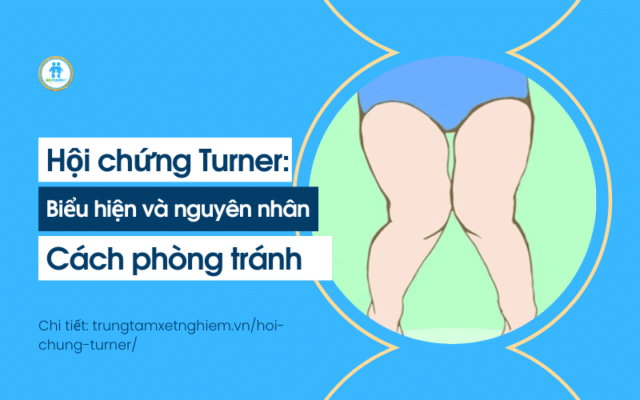 Hội chứng turner