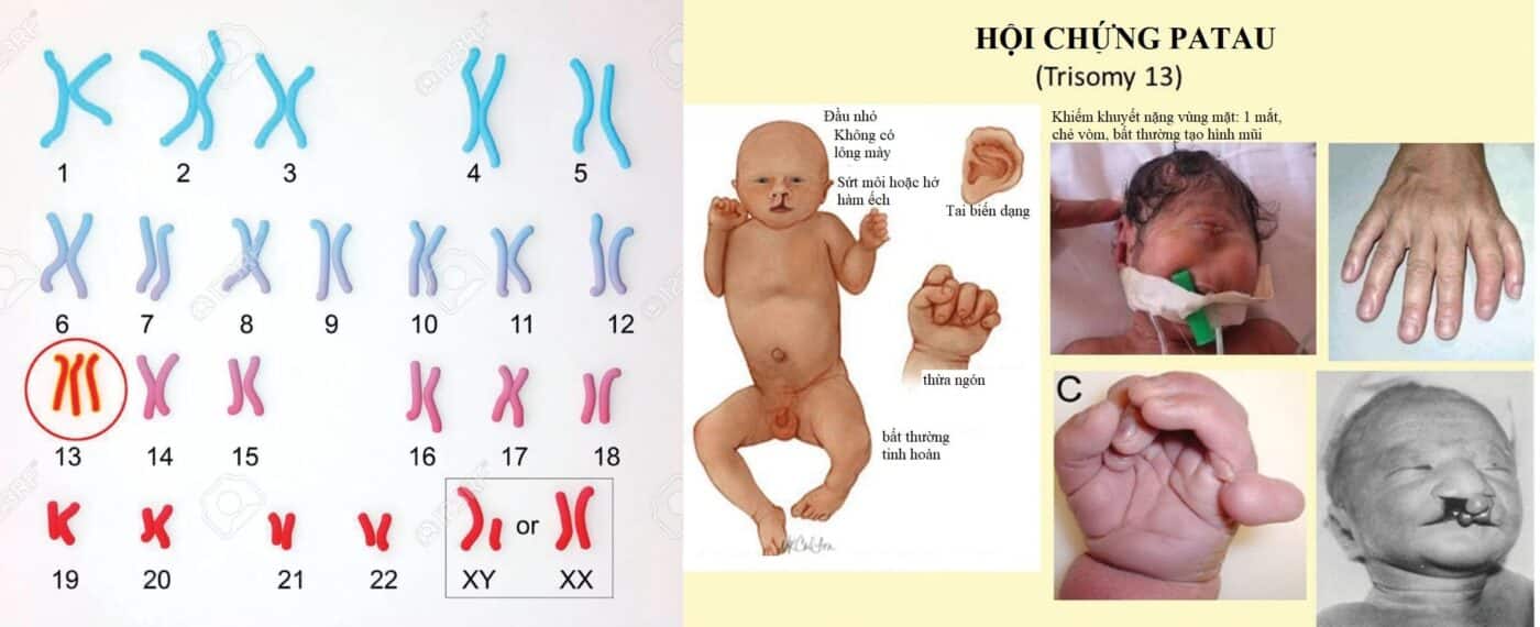 Trisomy 13 (hội chứng Patau)