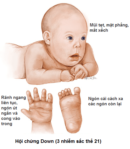 Trisomy 21 (hội chứng Down)