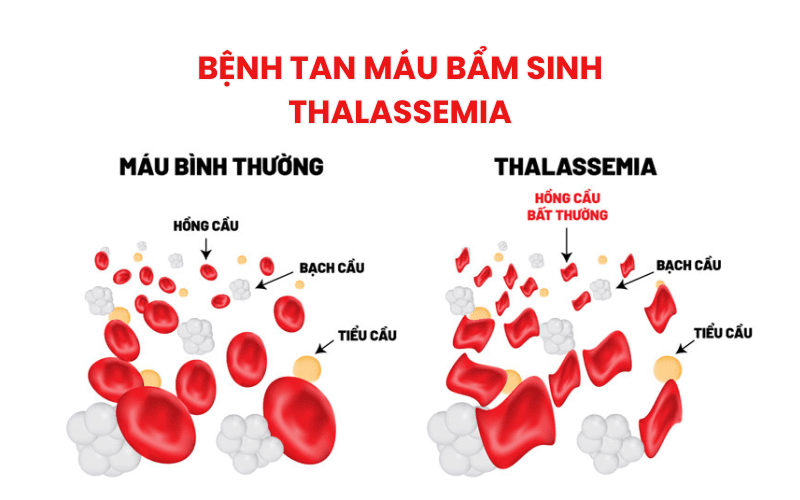 Bệnh Thalassemia