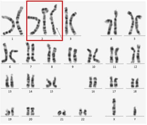 Bộ nhiễm sắc thể của người bị tam nhiễm sắc thể 2