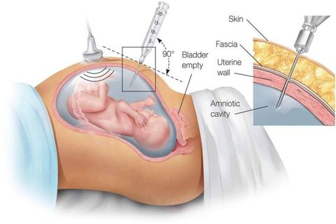 Chọc ối xét nghiệm ADN có nguy hiểm không? Giải đáp từ chuyên gia 4 Hình vẽ vị trí lấy nước ối trong tử cung